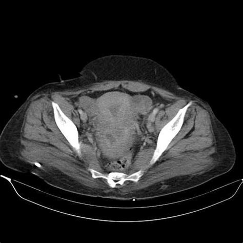 Squamous Cell Carcinoma Of The Cervix Radiology Case