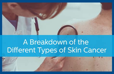 A Breakdown Of The Different Types Of Skin Cancer Avail Dermatology