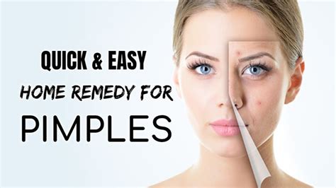 Quick And Easy Home Remedy For Pimples Home Remedies For Pimples