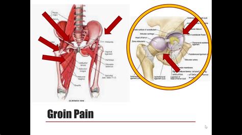 Hip Pathology Soft Tissue Anterior Groin Pain Youtube