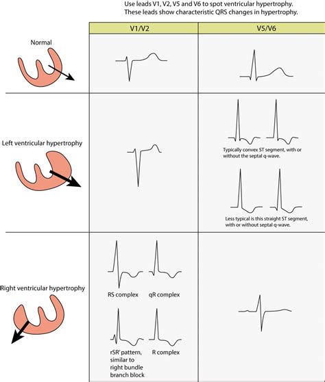 Right Ventricular Hypertrophy Rvh Ecg Criteria And Clinical