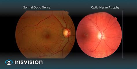 What Diseases Cause Optic Atrophy Irisvision