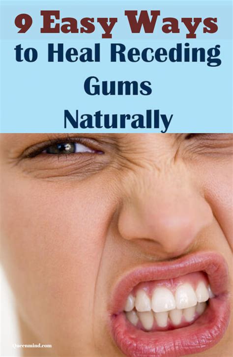 How To Heal Receding Gums Naturally Ways For Beauty Receding Gums