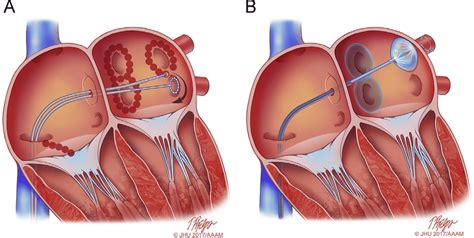 Pulmonary Veins Stenosis After Catheter Ablation Of Atrial Fibrillation Images And Photos Finder