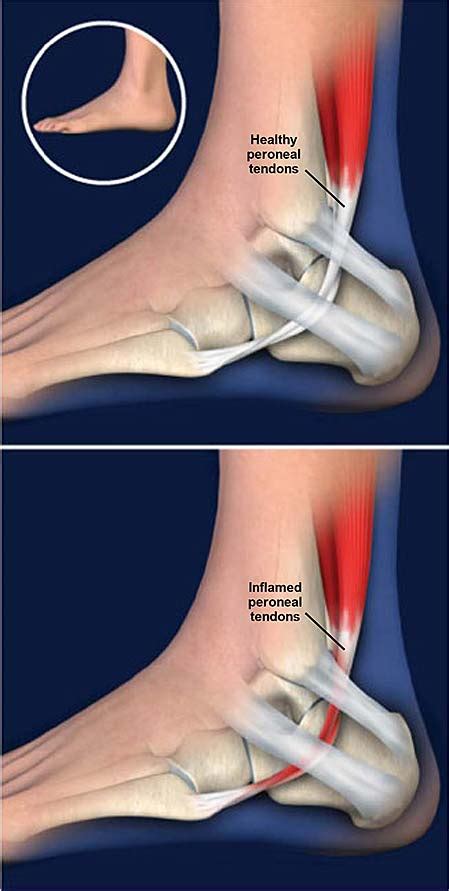 Peroneal Tendonitis Central Coast Orthopedic Medical Group