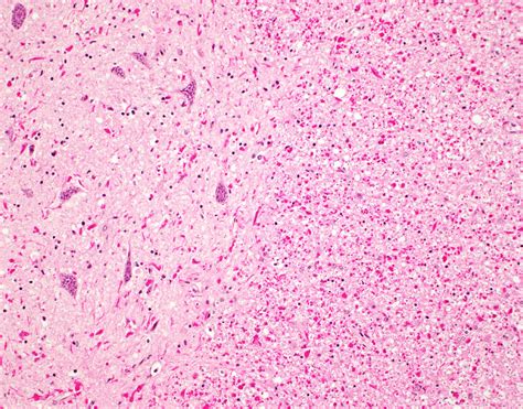 Neuropathology Blog A Case Of Alexander Disease
