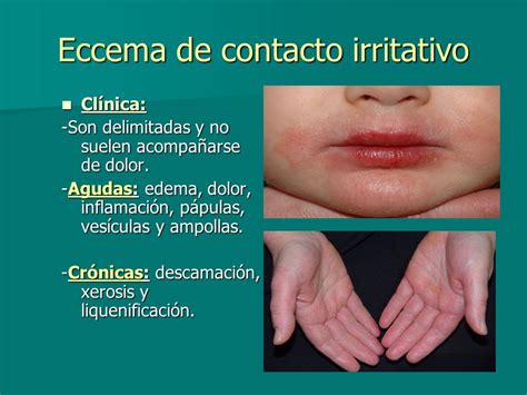 Dermatitis De Contacto Farmacia Ulm San Fulgencio Alicante