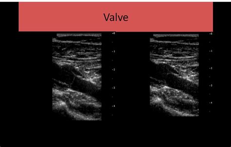 Ultrasound Registry Review Extremity Venous