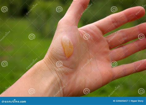 Human Hand With A Burn Blister Manand X27s Hand With A Fluid Filled