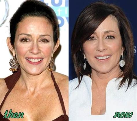Patricia Heaton Plastic Surgery Before And After Patricia Heaton