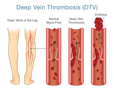 Other times, blood clots are found by accident when checking for other things. Know the Signs and Symptoms of Deep Vein Thrombosis