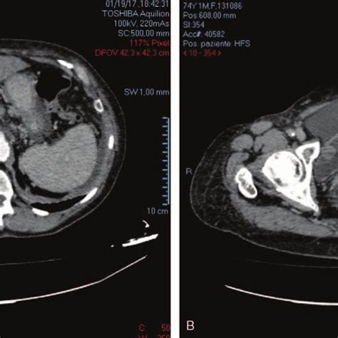 Abdominal Computed Tomography Ct Scanning Showing A A 68 Mm Liver