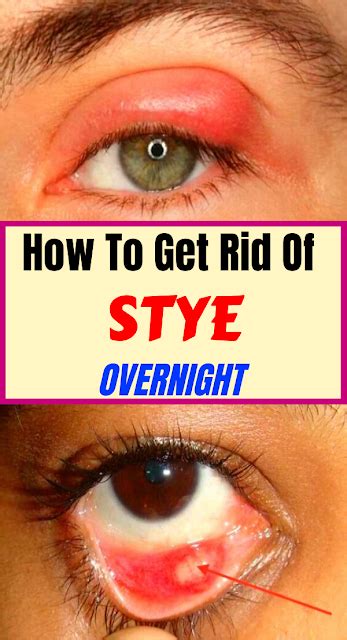 How To Get Rid Of A Stye Overnight V Remedies