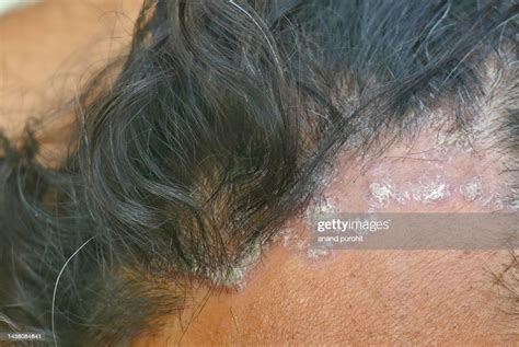 Seborrheic Dermatitis High Res Stock Photo Getty Images