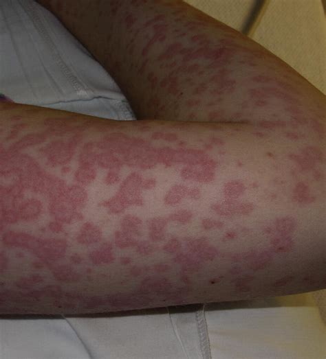 Erythema Multiforme Minor After Ibuprofen Use For Menstrual Pain