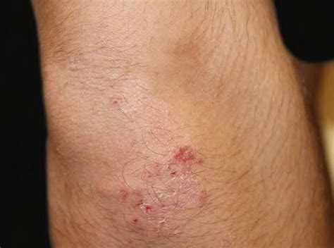 Dermatitis Herpetiformis Elbow Dermatitis Herpetiformis Dermatitis