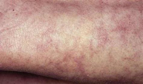 Mottled Skin Causes Pictures Baby Mottled Skin On Legs Arms