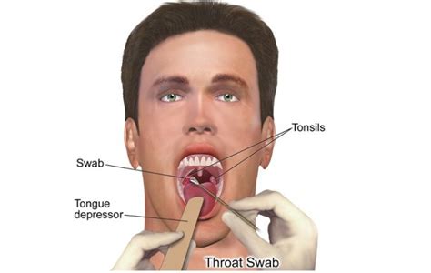 Sore Throat Allergies A Health Tutor