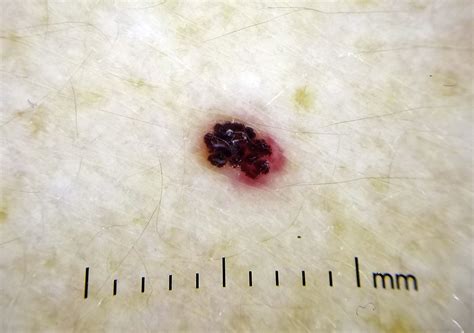 Heparin Induced Bullous Hemorrhagic Dermatosis A Report Of 3 Cases