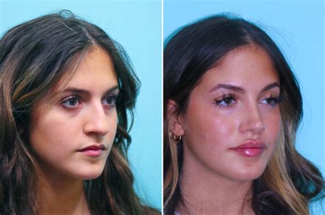 Lip Augmentation Before And After Photos The Naderi Center For