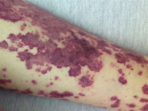 Petechiae Causes Treatments And Pictures