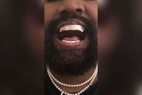 Kanye West Replaced His Teeth With Titanium Prosthesis For 850 Thousand