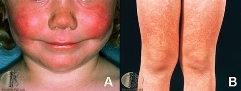 Common And Not So Common Rashes In Kids