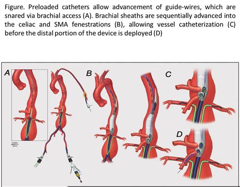 Scvs Preloaded Catheters And Guide Wire Systems To Facilitate