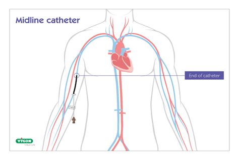 The Varying Terminology Surrounding Midline Catheters Campus Vygon