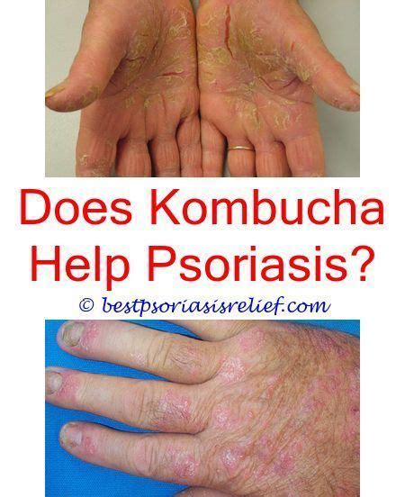 What Is Vitiligo In 2020 With Images Scalp Psoriasis Cure Natural