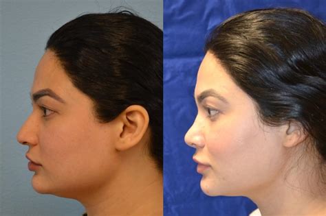 Nose Surgery Before And After Photos Patient 189 San Francisco Ca