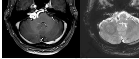 Preoperative Mri A Gadolinium Enhanced T1 Weighted Image Showing The