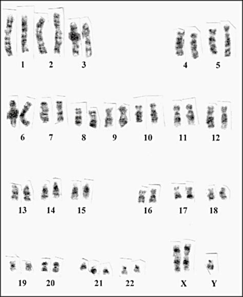 Complete Karyotype Of The Child With Downklinefelter Syndrome By