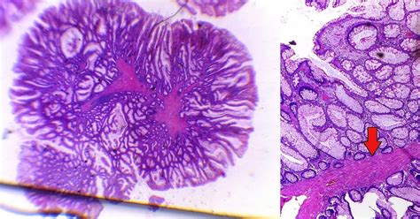 gastrointestinal and liver histology pathology atlas colon hamartomatous polyp including