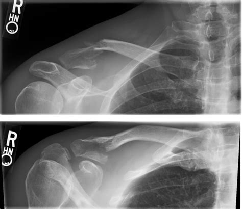 Figure 1 From Open Reduction And Internal Fixation Of A Distal Clavicle