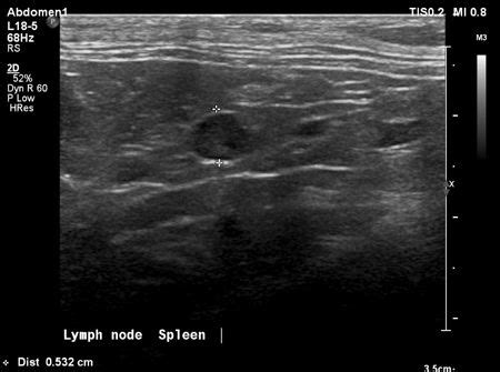 Your vet will examine the suspected tumor and will search your cat with surgical removal of the tumor, most cats will recover and lead normal healthy lives. A splenic mast cell tumor in an 11-year old Siamese cat ...
