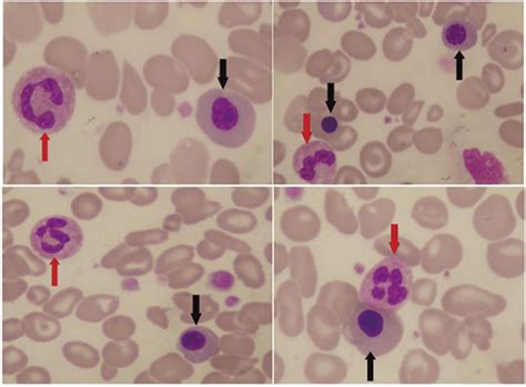 − A Peripheral Blood Smear 100× Leishmans Stain Indicating