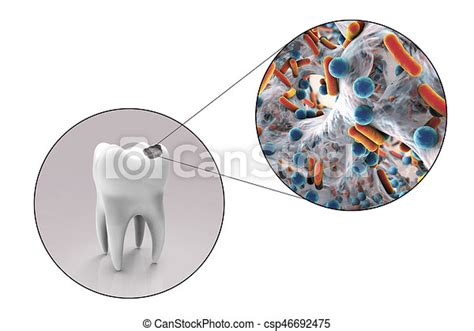 L'évolution d'une carie dentaire est sournoise, car au début on ne voit rien et on ne sent rien. Carie dentaire, dent. Gros plan, microbes, dentaire ...