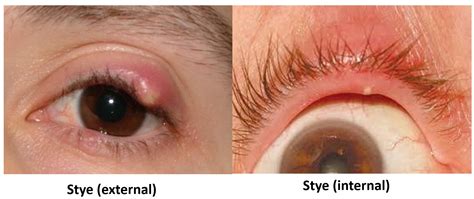 Swollen Eyelid Know The Causes Remedies And Alert Signs