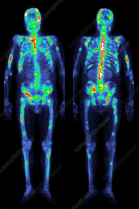 Secondary Bone Cancer Gamma Scan Stock Image M1340711 Science