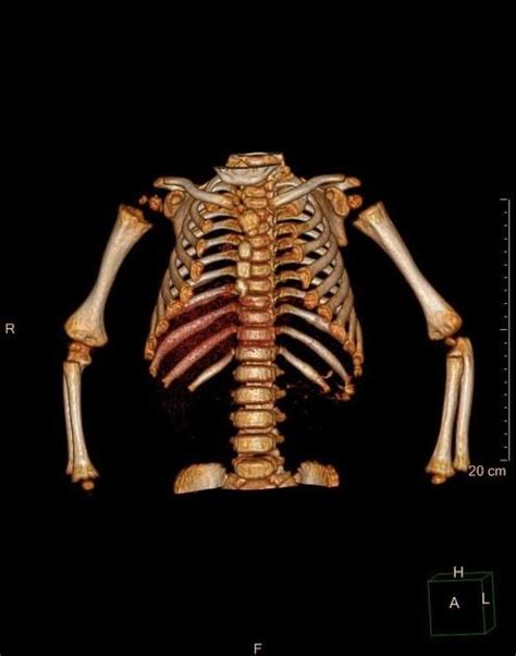 Rickets Radiology Case Radiology Case Pectus