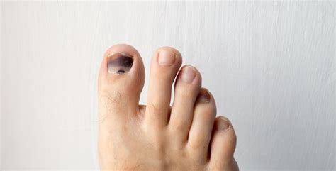 En each of the five digits on the end of the foot. Cek Anda Diabetes atau Tidak lewat Warna Jari Kaki ...