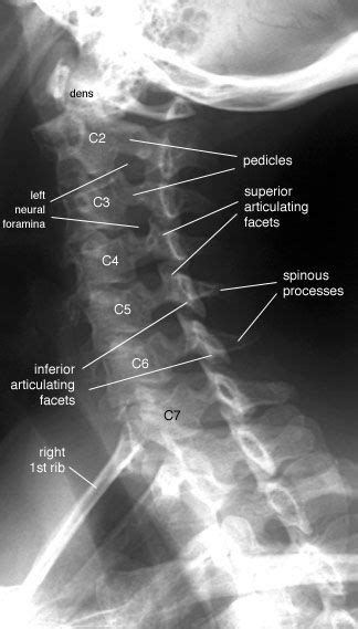 Lateral Cervical X Ray Connorzebsteele