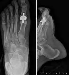 Treatment Of End Stage Hallux Rigidus Using Total Joint Arthroplasty A