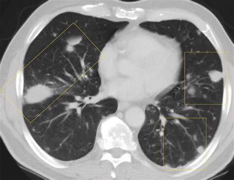 Noninfectious Granulomatous Diseases Of The Chest Radiographics