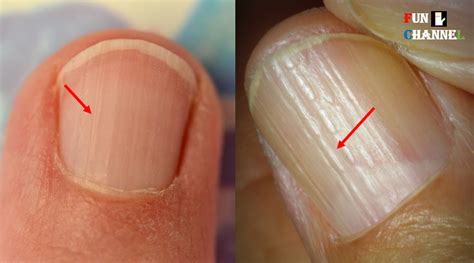 Do You Have These Vertical Ridges On Your Nails