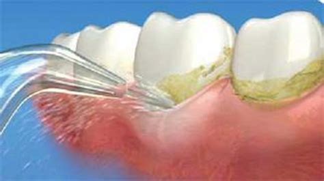 Biofilm Removal Registered Dental Hygienist Rdh Magazine