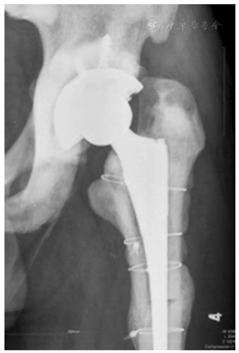 Case Report A 10 Years Follow Up Of Periprosthetic Femoral Fracture