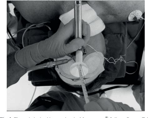 Pdf Salivary Bypass Tube Placement In Esophageal Stricture A