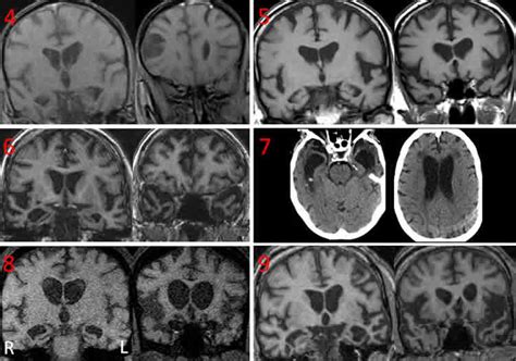 A brain injury can double your risk of developing dementia. Brain Scans of Dementia Patients with Coprophagia Showed ...